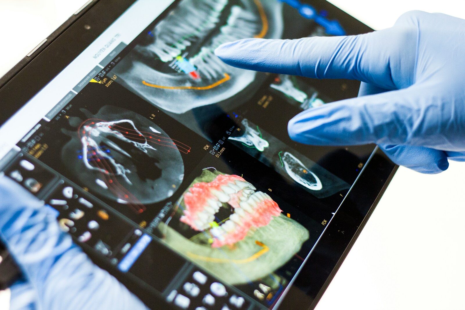 A person in blue medical gloves pointing at a dental scan on a tablet